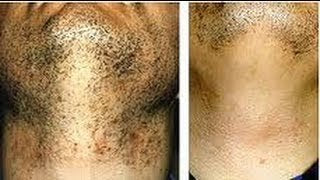 Gnatural Alpha Club Anti-Bump Skin Tonic Spray For Men. The NEXT Level in Razor Bump Protection, Use Shave Tonic Post-Shave for a Smooth Face Without RazorBumps. - Duafe Beauty Collective